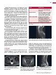 Vorschauseite 2: Anomalien und Normvarianten: Skelettale Veränderungen 3. 19 Spinale Zysten – Tarlov-Zyste