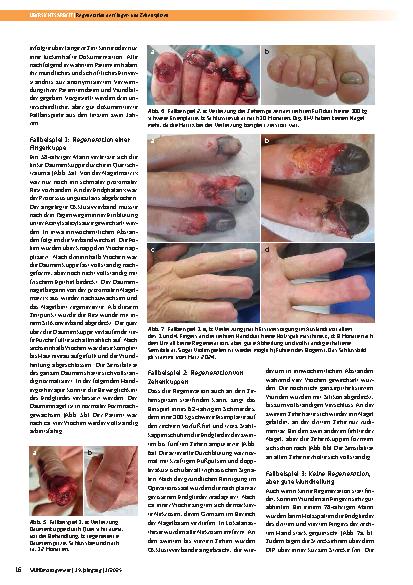 Vorschauseite 5: Regeneration der Fingerund Zehenspitzen nach Verletzungen