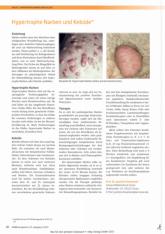 Vorschauseite 1: Hypertrophe Narben und Keloiden*