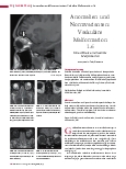 Vorschauseite 1: Anomalien und Normvarianten: Vaskuläre Malformation 1.6: Intraorbitale arteriovenöse Malformation