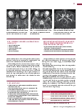 Vorschauseite 2: Anomalien und Normvarianten: Vaskuläre Malformation 1.6: Intraorbitale arteriovenöse Malformation