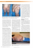 Vorschauseite 3: Adipositas und chronische Wunden