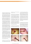 Vorschauseite 1: Reinigung einer geröteten perkutanen endoskopischen Gastrostomie-Einstichstelle mit einer Lösung auf Basis von Octenidinhydrochlorid und Phenoxyethanol – eine Fallbeobachtung