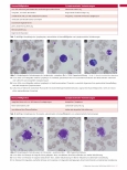Vorschauseite 2: COVID-19 und die morphologischen Veränderungen der Zellen im peripheren Blutausstrich