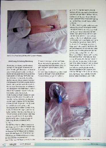 Vorschauseite 4: Der Kock-Pouch (kontinentes Ileostoma) - das wiederentfachte Interesse an einem alten Verfahren