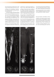 Vorschauseite 3: Magnetresonanz-Lymphangiographie bei Patienten mit Lymphödem