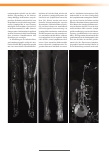 Vorschauseite 4: Magnetresonanz-Lymphangiographie bei Patienten mit Lymphödem
