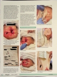 Vorschauseite 3: Abdomen apertum/ enteroatmosphärische Fistel - nicht einfach nur eine Diagnose