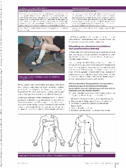 Vorschauseite 3: Lymphödem nach Krebstherapie