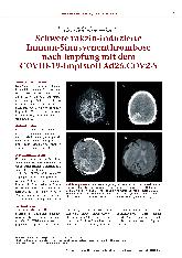 Vorschauseite 1: Schwere vakzin-induzierte Immun-Sinusvenenthrombose nach Impfung mit dem COVID-19-Impfstoff Ad26.COV2-S.