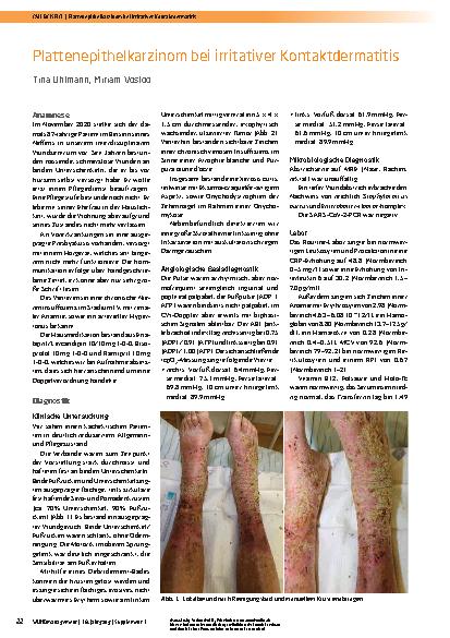 Vorschauseite 1: Plattenepithelkarzinom bei irritativer Kontaktdermatitis