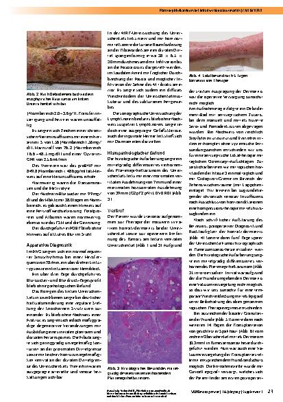 Vorschauseite 2: Plattenepithelkarzinom bei irritativer Kontaktdermatitis