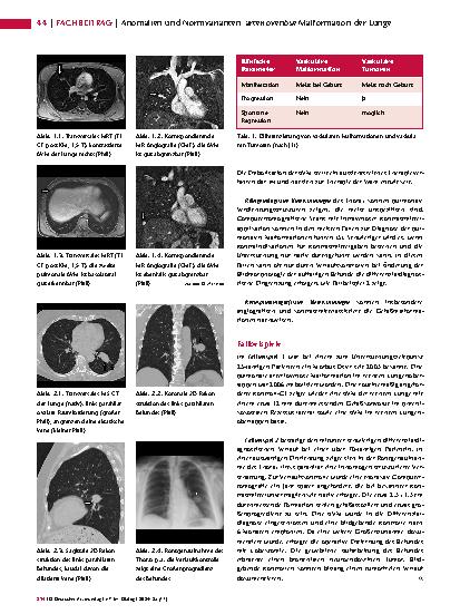 Vorschauseite 2: Anomalien und Normvarianten – Interne Veränderungen 2. 25: arteriovenöse Malformation der Lunge