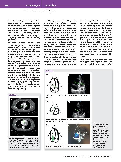 Vorschauseite 2: Postpartale Thrombolysetherapie bei zentraler Lungenarterienembolie