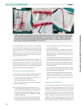Vorschauseite 5: Der femoro-popliteale Bypass