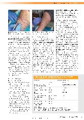 Vorschauseite 4: Wundhygiene - ein neues Konzept, um chronischen Wunden frühzeitig mit einer Anti-Biofilm-Interventionsstrategie zu begegnen.