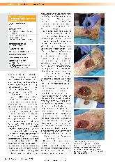 Vorschauseite 5: Wundhygiene - ein neues Konzept, um chronischen Wunden frühzeitig mit einer Anti-Biofilm-Interventionsstrategie zu begegnen.