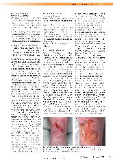 Vorschauseite 6: Wundhygiene - ein neues Konzept, um chronischen Wunden frühzeitig mit einer Anti-Biofilm-Interventionsstrategie zu begegnen.