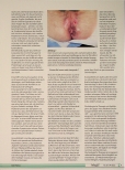 Vorschauseite 2: Stoma bei Patienten mit M. Crohn und Befall des Dickdarms und des Afters The corrected text is: Stoma bei Patienten mit M. Crohn und Befall des Dickdarms und des Afters