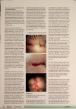 Vorschauseite 3: Stoma bei Patienten mit M. Crohn und Befall des Dickdarms und des Afters The corrected text is: Stoma bei Patienten mit M. Crohn und Befall des Dickdarms und des Afters