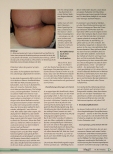 Vorschauseite 4: Stoma bei Patienten mit M. Crohn und Befall des Dickdarms und des Afters The corrected text is: Stoma bei Patienten mit M. Crohn und Befall des Dickdarms und des Afters