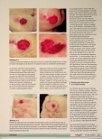 Vorschauseite 6: Stoma bei Patienten mit M. Crohn und Befall des Dickdarms und des Afters The corrected text is: Stoma bei Patienten mit M. Crohn und Befall des Dickdarms und des Afters