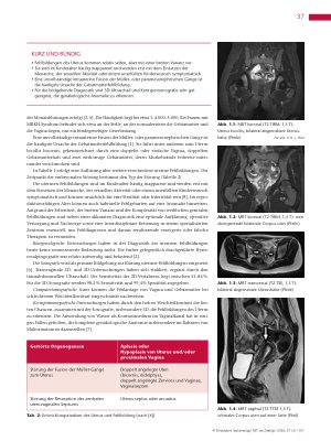 Vorschauseite 2: Anomalien und Normvarianten- Interne Veränderungen 2.32. Uterus bicollis bicornis