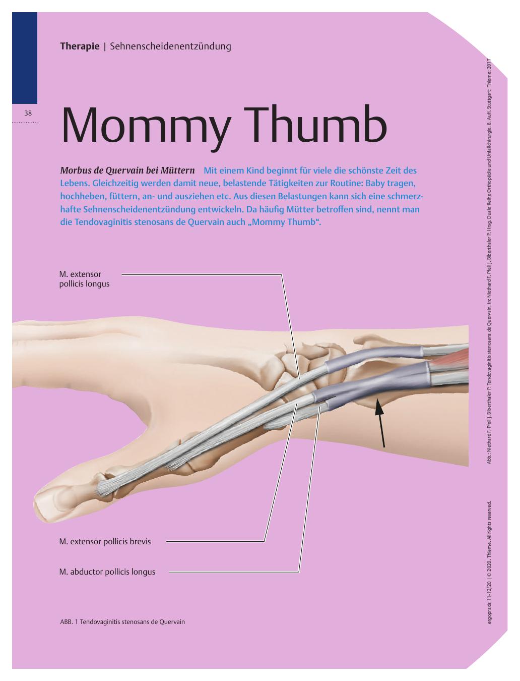 Vorschauseite 1: Mommy Thumb - Morbus de Quervain bei Müttern