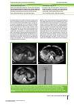 Vorschauseite 3: Interventionelle Onkologie Teil 2 – Ablative Verfahren und palliative Therapien