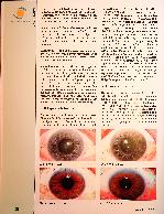 Vorschauseite 3: Irisdiagnose und Depression. Durch Irisdiagnostik lässt sich eine Depression zielgerichtet behandeln.