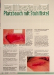Vorschauseite 1: Platzbauch mit Stuhlfistel