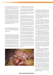 Vorschauseite 3: Operative Therapie des Lymphödems