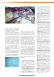 Vorschauseite 5: Operative Therapie des Lymphödems
