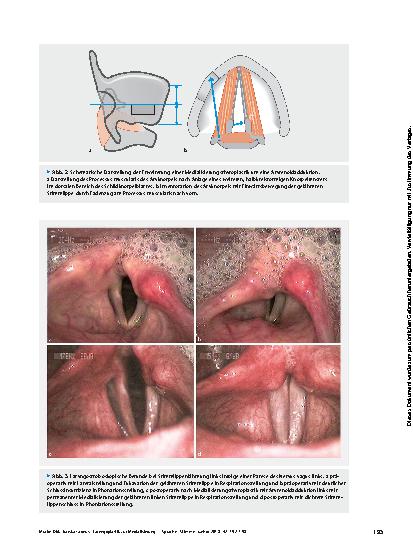 Vorschauseite 4: Laryngoplastik zur Medialisierung bei Lähmungen und Defekten der Glottis