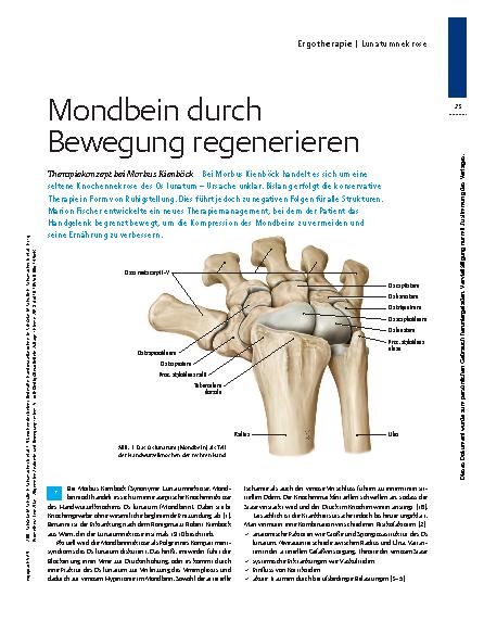 Vorschauseite 1: Mondbein durch Bewegung regenerieren – Therapiekonzept bei Morbus Kienböck