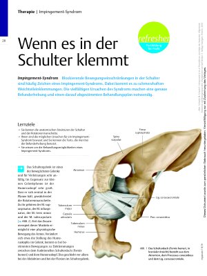 Vorschauseite 1: Wenn es in der Schulter klemmt – Impingement-Syndrom