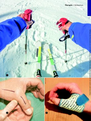 Vorschauseite 2: Après-Ski in der Handtherapie – Skidaumen