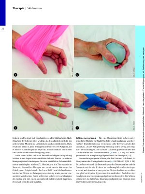 Vorschauseite 3: Après-Ski in der Handtherapie – Skidaumen