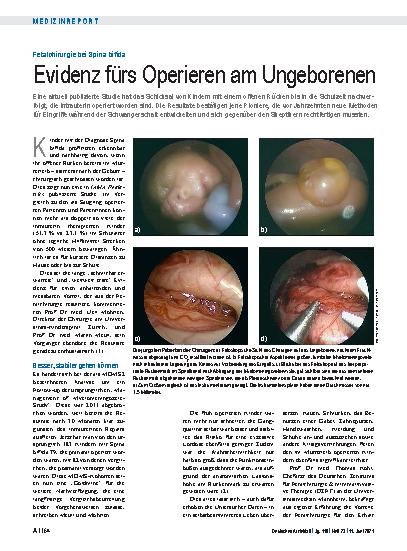 Vorschauseite 1: Fetalchirurgie bei Spina bifida: Evidenz fürs Operieren am Ungeborenen