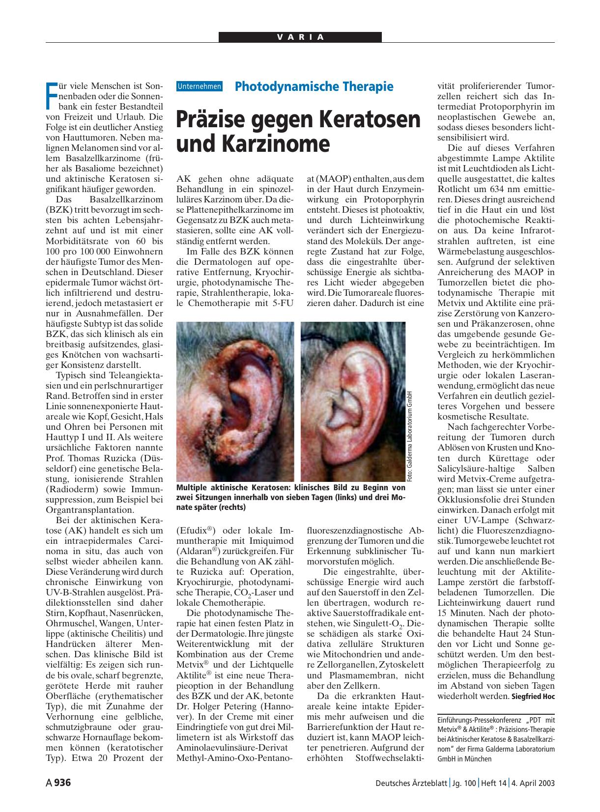 Vorschauseite 1: Photodynamische Therapie: Präzise gegen Keratosen und Karzinome