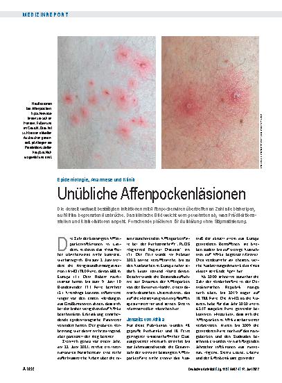 Vorschauseite 1: Epidemiologie, Anamnese und Klinik: Unübliche Affenpockenläsionen