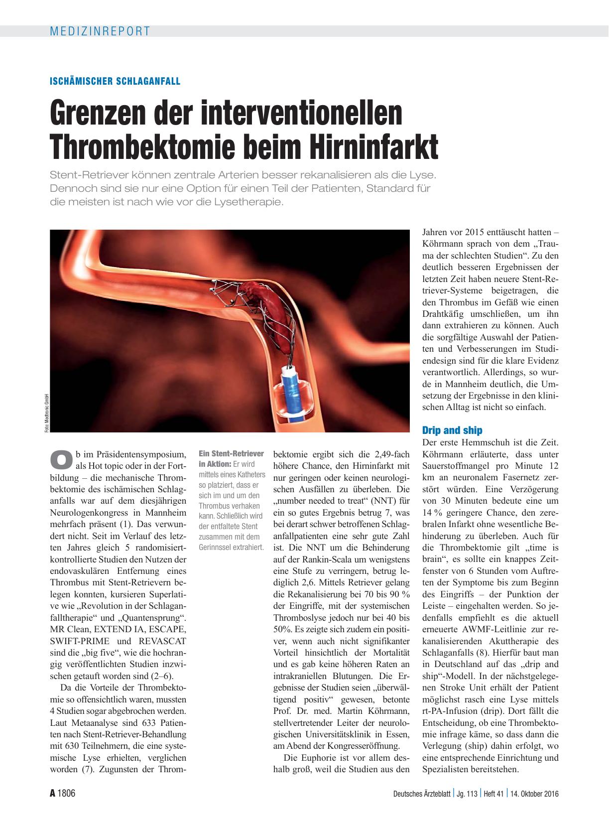 Vorschauseite 1: Ischämischer Schlaganfall: Grenzen der interventionellen Thrombektomie beim Hirninfarkt