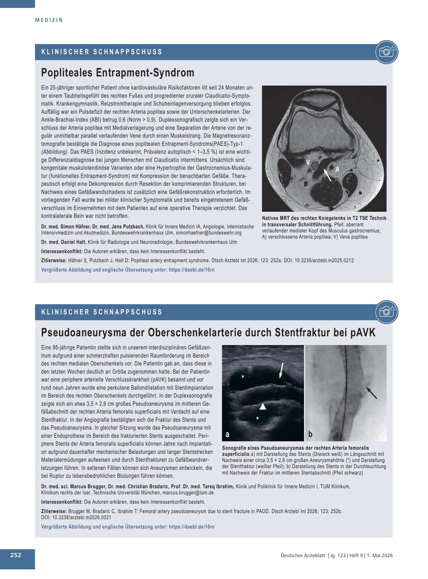 Vorschauseite 1: Popliteales Entrapment-Syndrom – Deutsches Ärzteblatt