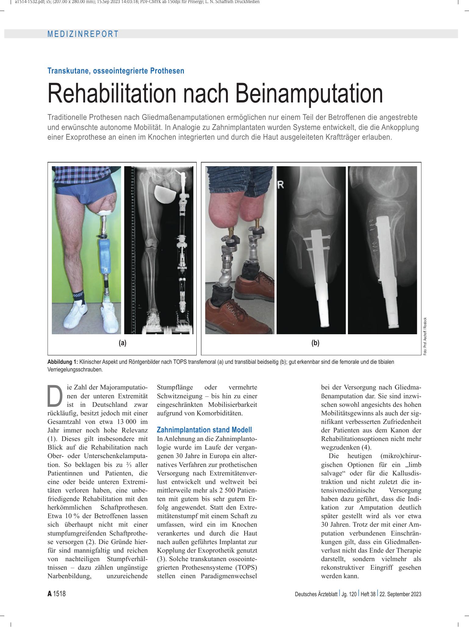Vorschauseite 1: Transkutane, osseointegrierte Prothesen: Rehabilitation nach Beinamputation – Deutsches Ärzteblatt