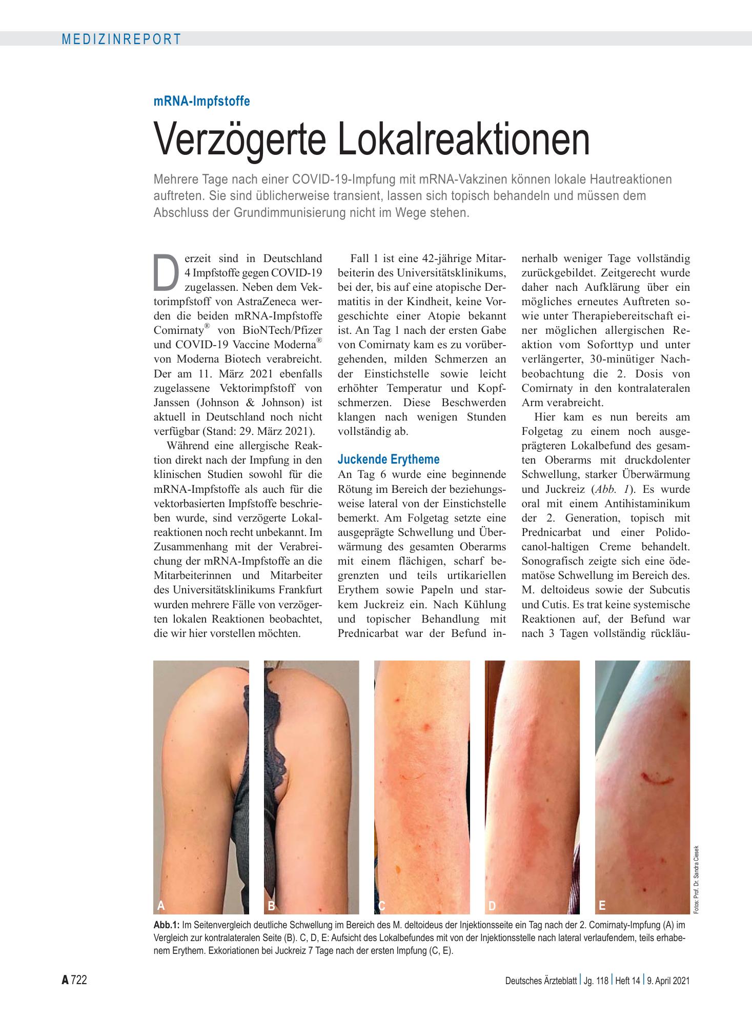 Vorschauseite 1: mRNA-Impfstoffe: Verzögerte Lokalreaktionen – Deutsches Ärzteblatt