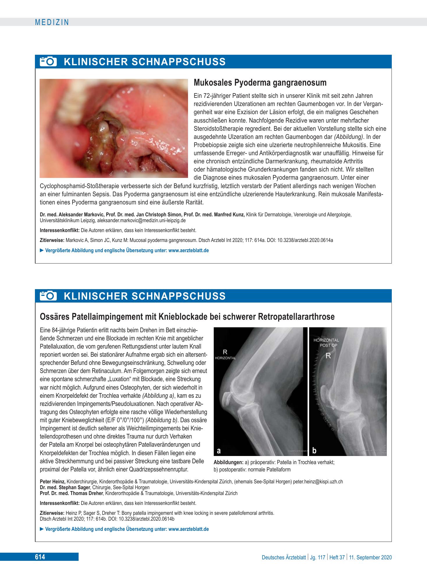 Vorschauseite 1: Mukosales Pyoderma gangraenosum – Deutsches Ärzteblatt