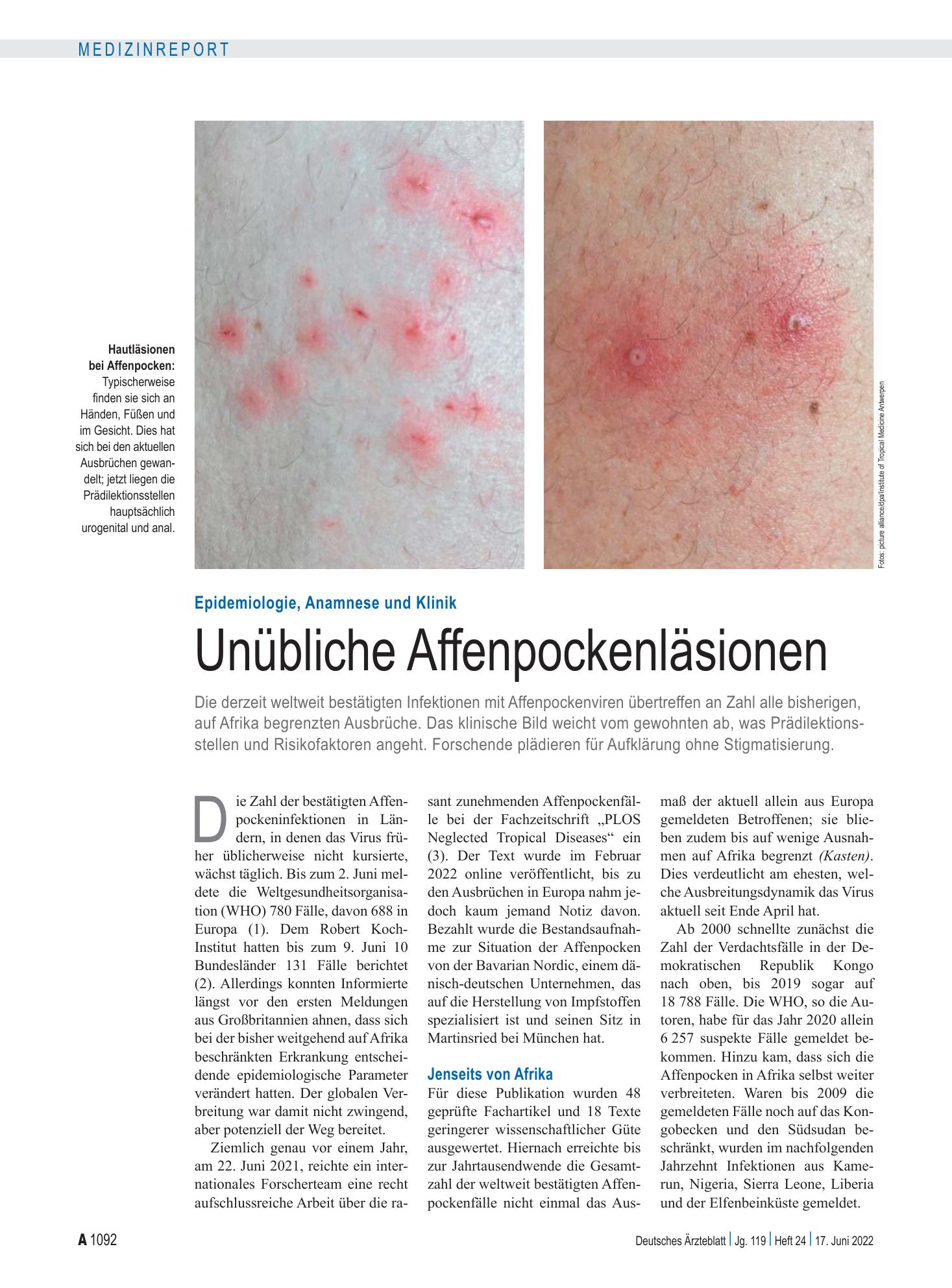 Vorschauseite 1: Epidemiologie, Anamnese und Klinik: Unübliche Affenpockenläsionen – Deutsches Ärzteblatt