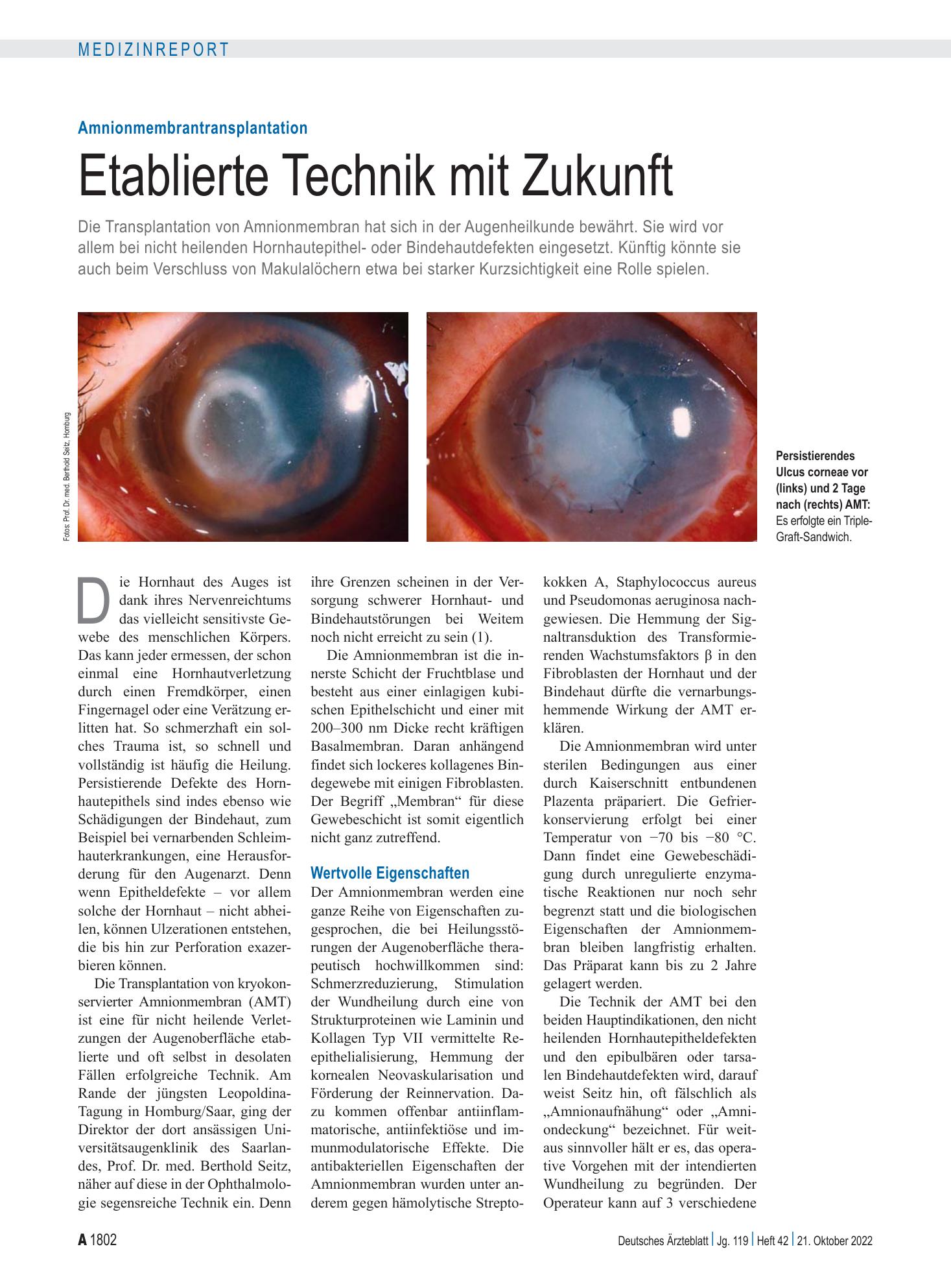 Vorschauseite 1: Amnionmembrantransplantation: Etablierte Technik mit Zukunft – Deutsches Ärzteblatt