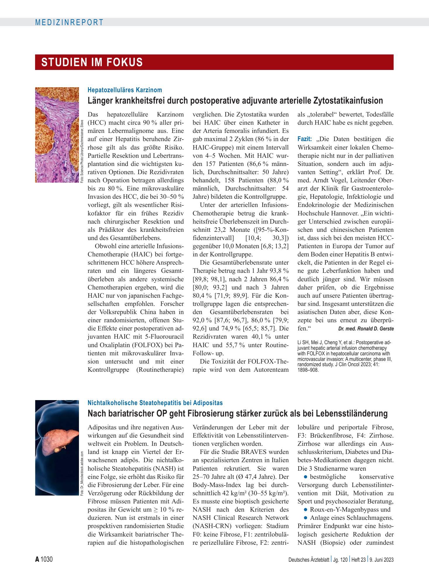 Vorschauseite 1: Hepatozelluläres Karzinom: Länger krankheitsfrei durch postoperative adjuvante arterielle Zytostatikainfusion – Deutsches Ärzteblatt
