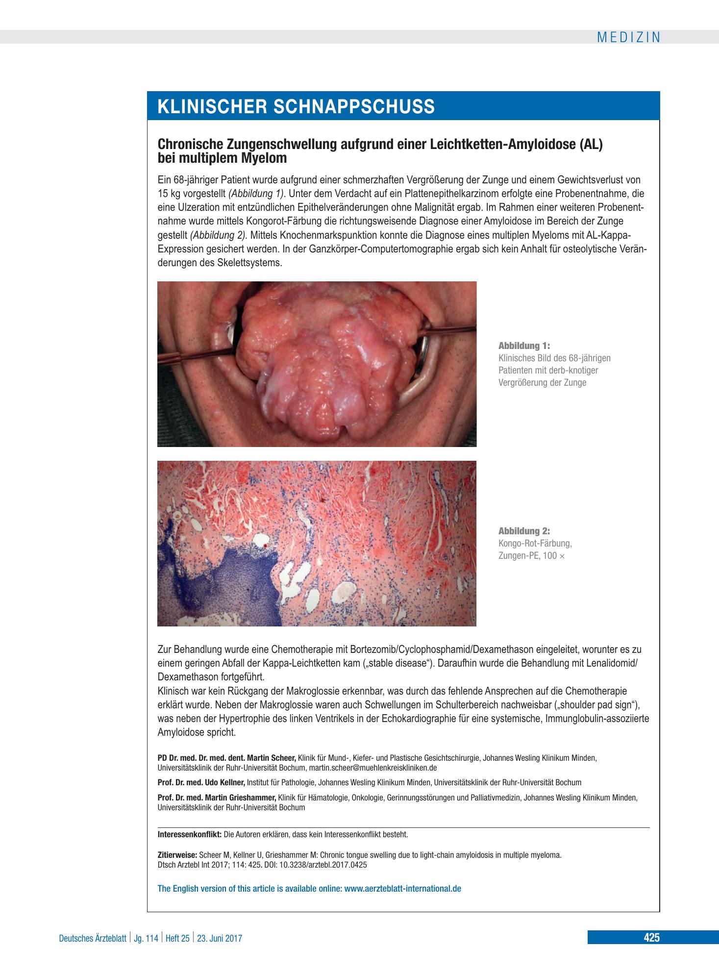 Vorschauseite 1: Chronische Zungenschwellung aufgrund einer Leichtketten-Amyloidose (AL) bei multiplem Myelom – Deutsches Ärzteblatt